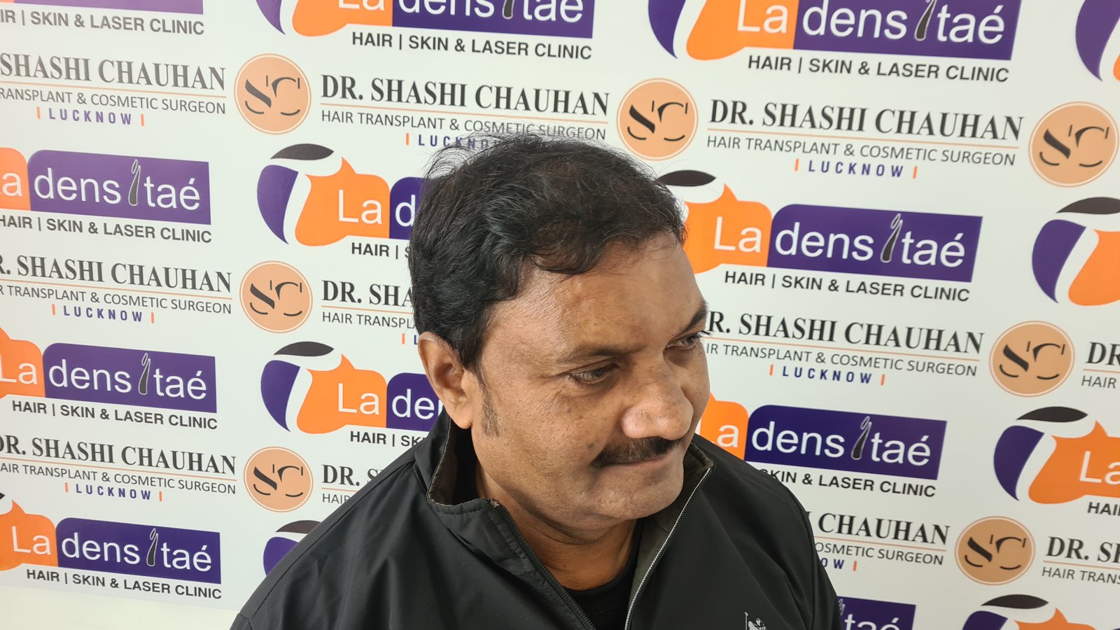 AK Singh After Hair Transplant